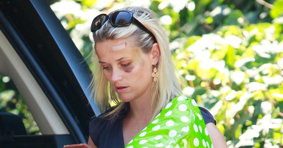 Celebrity Injuries