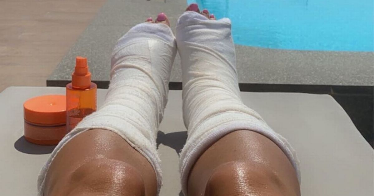 Katie Price jokes about her odd tan lines as she sunbathes with casts on feet