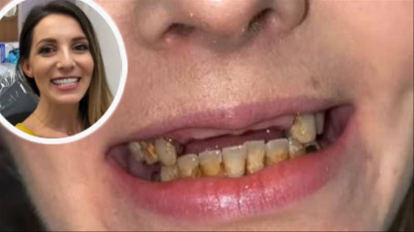 Dentist Repairs Woman’s Teeth After She Hid Her Smile For Years